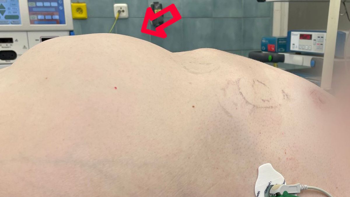Pacientovi v Ostravě vyoperovali nádor o hmotnosti 2,6 kila. Zákrok odkládal kvůli covidu